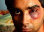 bruised-indian_student