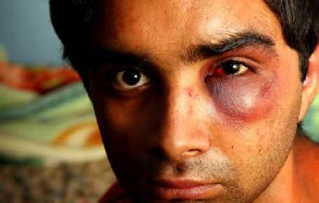 http://www.teluglobe.com/wp-content/uploads/2010/06/bruised-indian_student.jpg